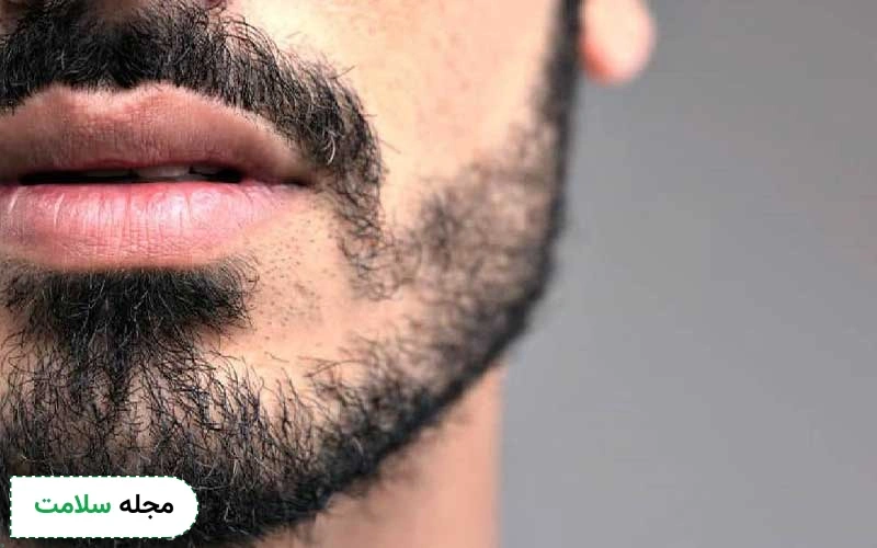 عوارض کاشت ریش و سبیل چقدر جدی است؟ بعد از چند وقت برطرف میشود؟