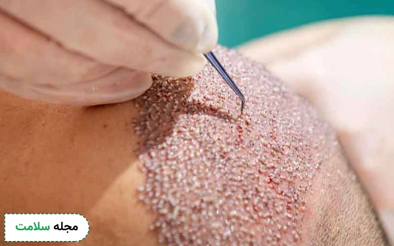 احتمال مرگ در اثر کاشت مو چقدر است؟