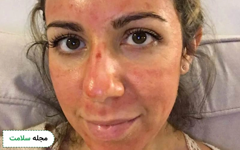 قرمزی بعد از لیفت صورت با نخ