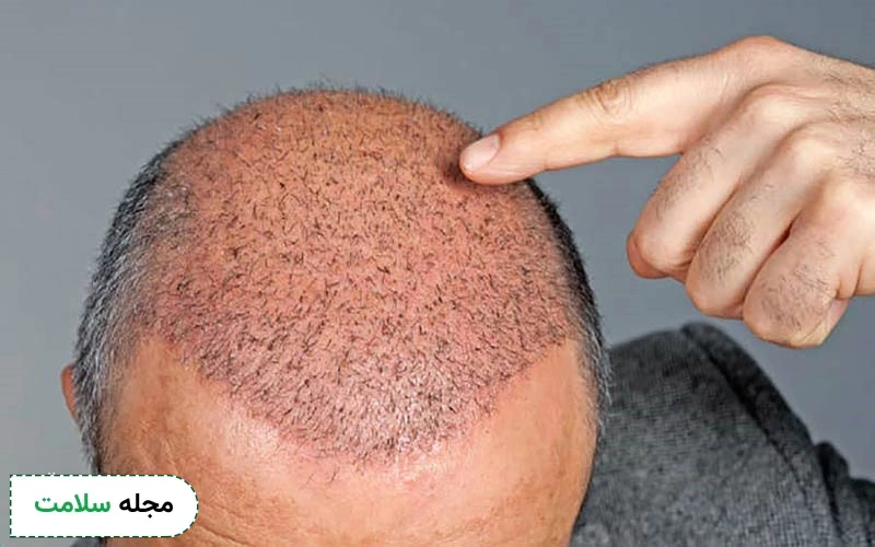 سوختگی و تغییر رنگ پوست سر از آثار قرار گرفتن در معرض نور آفتاب بعد از کاشت مو است.