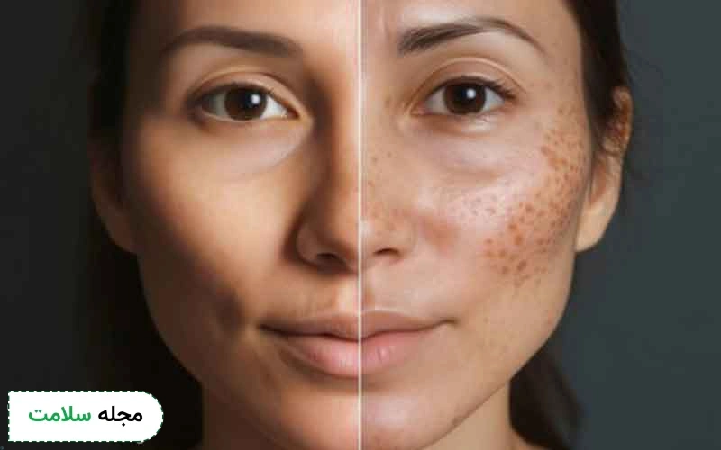 مزوتراپی صورت برای لک تا چه اندازه موثر است؟