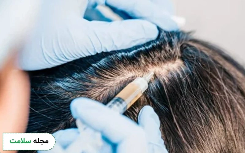عوامل مؤثر در بروز عوارض پی آر پی مو چیست؟