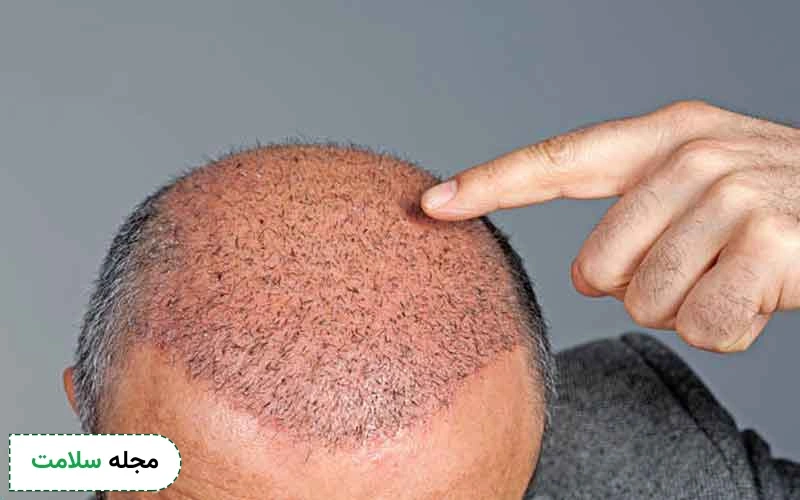 عکس ریزش مو بعد از کاشت چگونه است؟