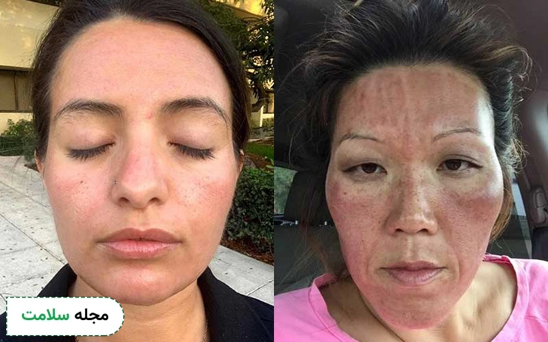 عکس لک بعد از میکرونیدلینگ بدین شکل است.