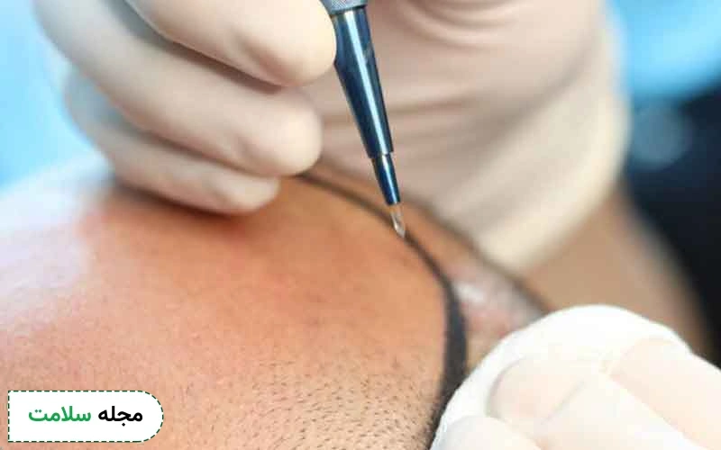 همه آنچه که باید درباره کاشت مو به روش dhi بدانید