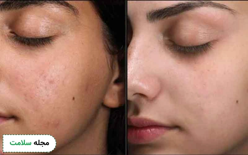 عکس فیشیال صورت قبل و بعد بدین شکل است.