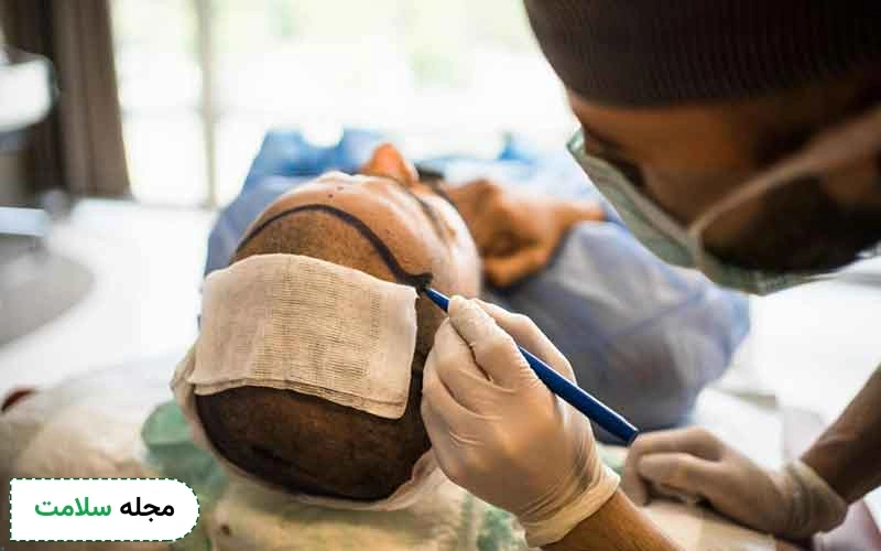 آشنایی با جدیدترین روش کاشت مو