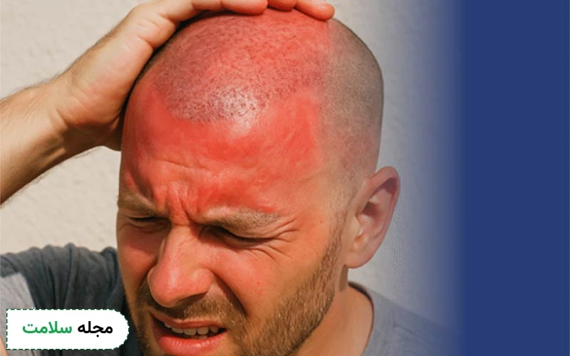 علت خارش سر بعد از کاشت مو چیست و چگونه آن را مهار کنیم؟