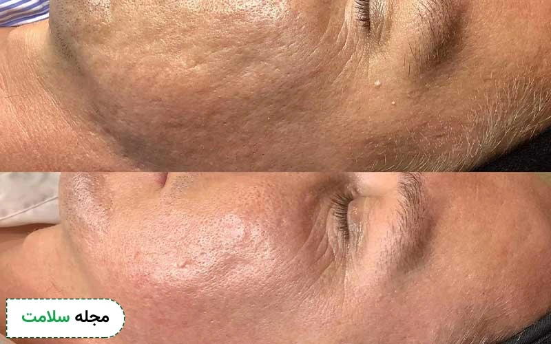 عکس قبل و بعد از مزونیدلینگ چگونه است؟