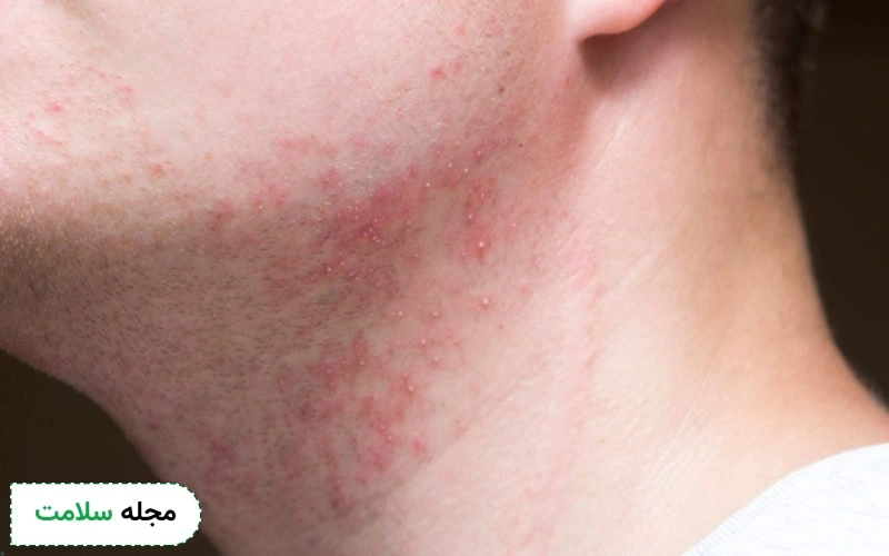 علائم جوش بعد از اصلاح در افراد متفاوت است.