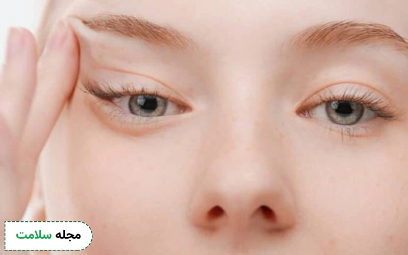 بوتاکس چشم گربه ای چگونه انجام میشود؟ مزایا، عوارض و نکات مراقبتی آن چیست؟