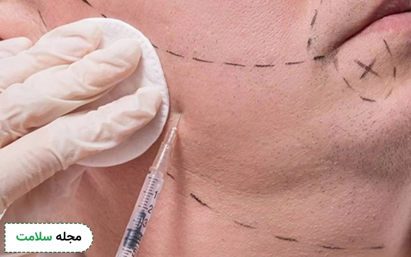 آیا نظرات در مورد مزوتراپی ریش مثبت است؟
