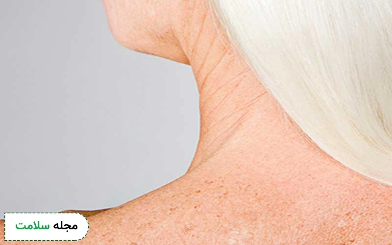 بوتاکس گردن چین و چروک این ناحیه را برطرف می کند.