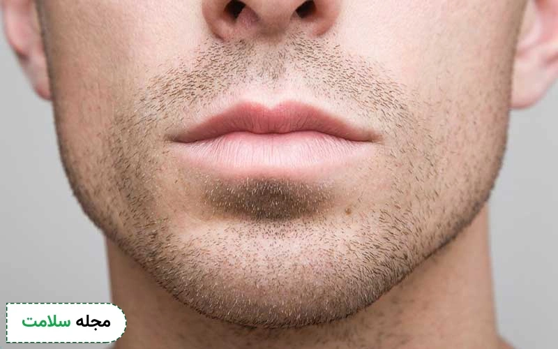 بوتاکس چانه و غبغب برای رفع چین و چروک انجام می شود.