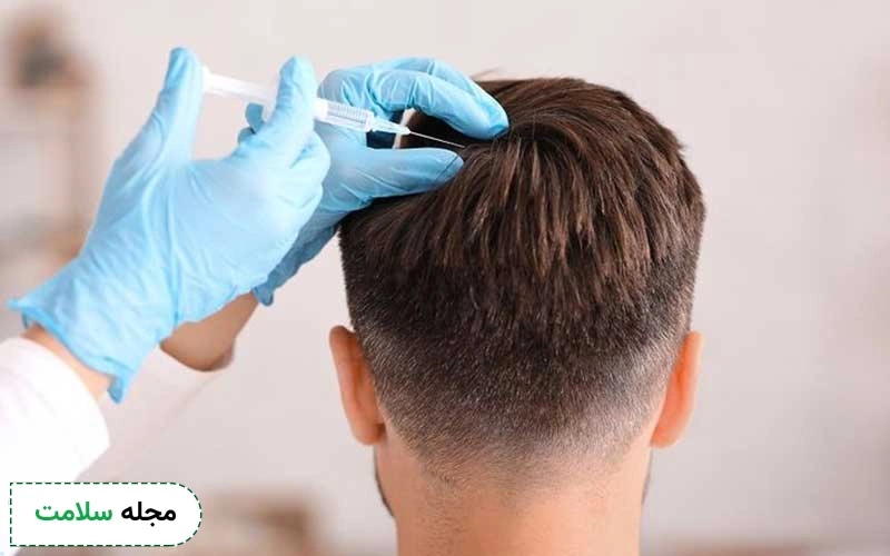 مزوتراپی بعد از کاشت مو چه اثراتی بر نتیجه آن دارد؟ مزایا و عوارض آن چیست؟