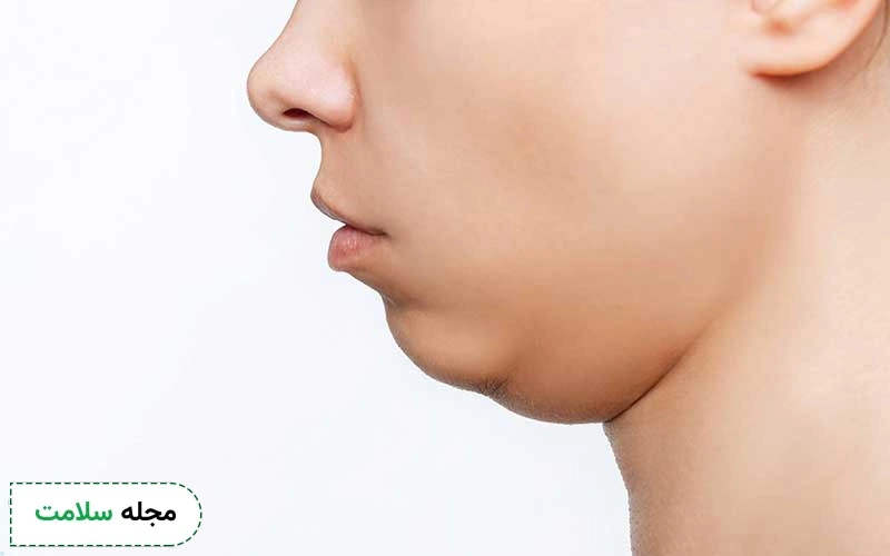بوتاکس چانه و غبغب چیست؟ آیا به رفع چین و چروک چانه کمک میکند؟