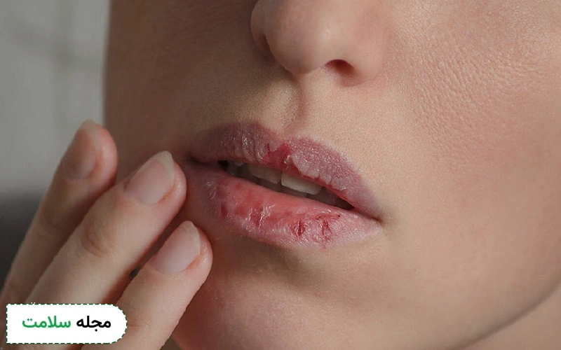 علت ترک خوردن گوشه لب چیست؟ دلیل خشکی لب و ترک گوشه لب