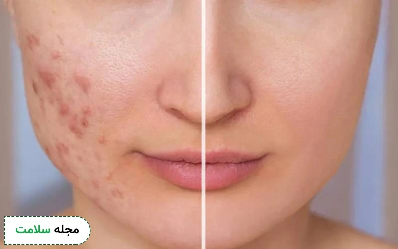 عکس قبل و بعد سابسیژن را مشاهده می کنید.