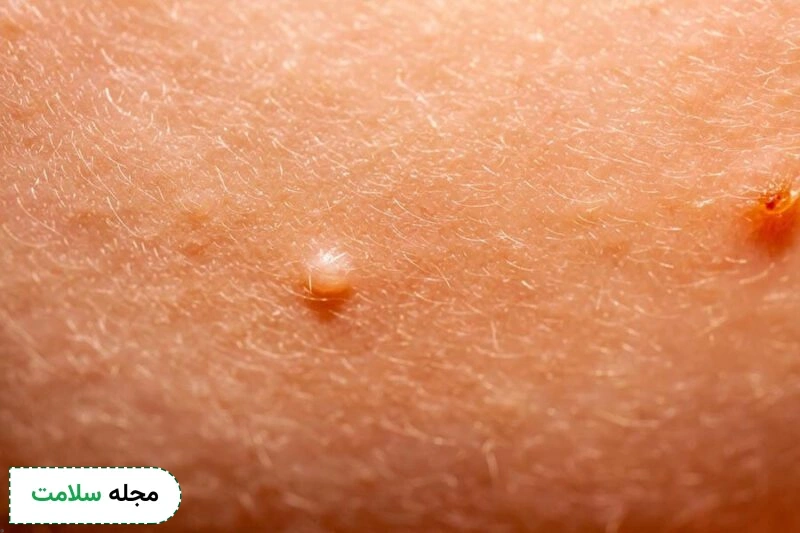 مولوسکوم کونتاژیوزوم یا زگیل آبکی چیست و چگونه درمان می شود؟