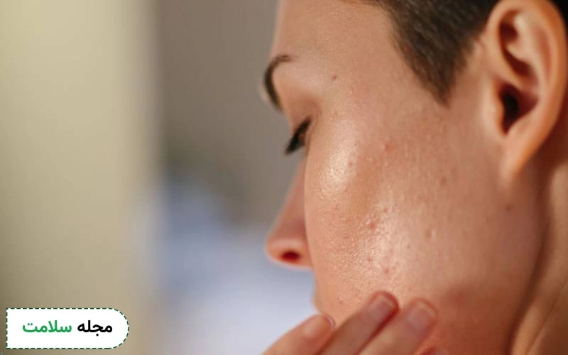 روش انجام سابسیژن با اندولیفت برای رفع جای جوش استفاده میشود.