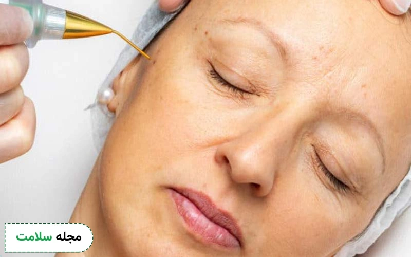 مزایای پلاسماتراپی پوست، عوارض و نکات مراقبتی PRP پوست