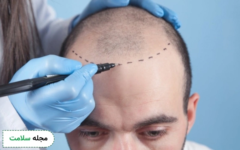 کاشت مو به روش FIT چگونه انجام می‌ شود؟ مزایا، معایب و نحوه انجام آن