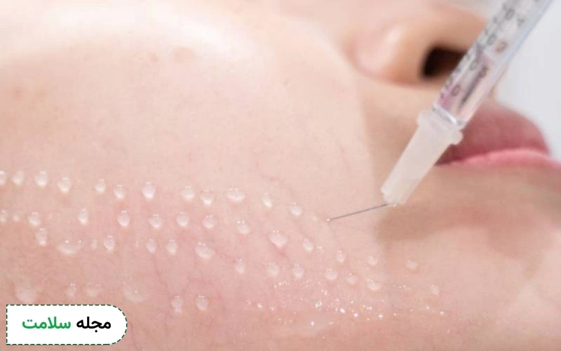 آیا مزوتراپی صورت عوارض دارد؟