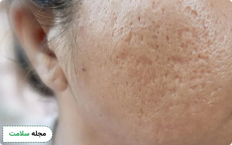 جای جوش روی پوست صورت ممکن است به شکل یک نقطه سرخ یا سفید در سطح پوست دیده شود.