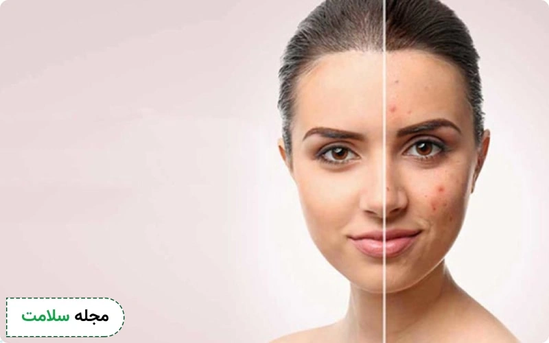 13 روش از بین بردن جای جوش از درمان پزشکی تا روش خانگی
