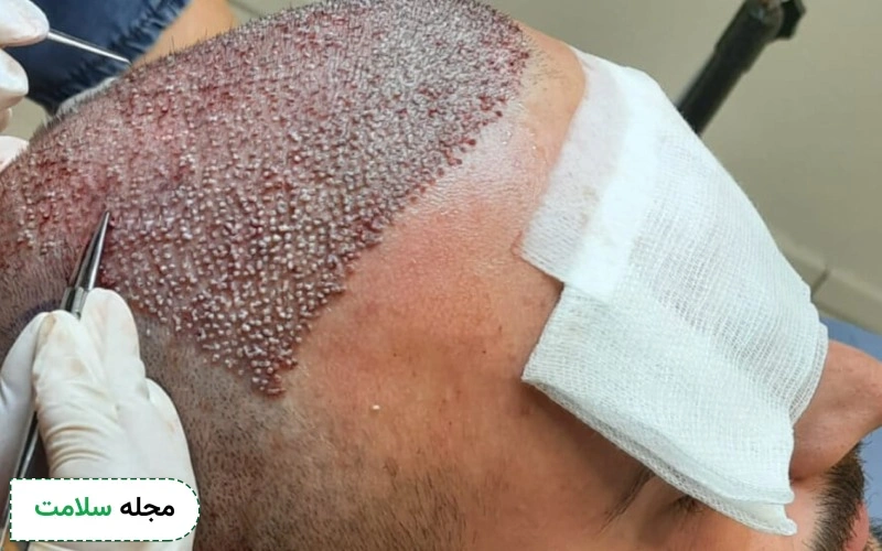 عوارض و خطرات کاشت مو به روش fue