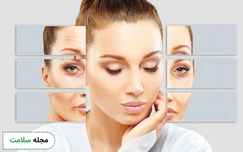 از عوارض هایفوتراپی دور چشم میتوان به قرمزی اشاره کرد.