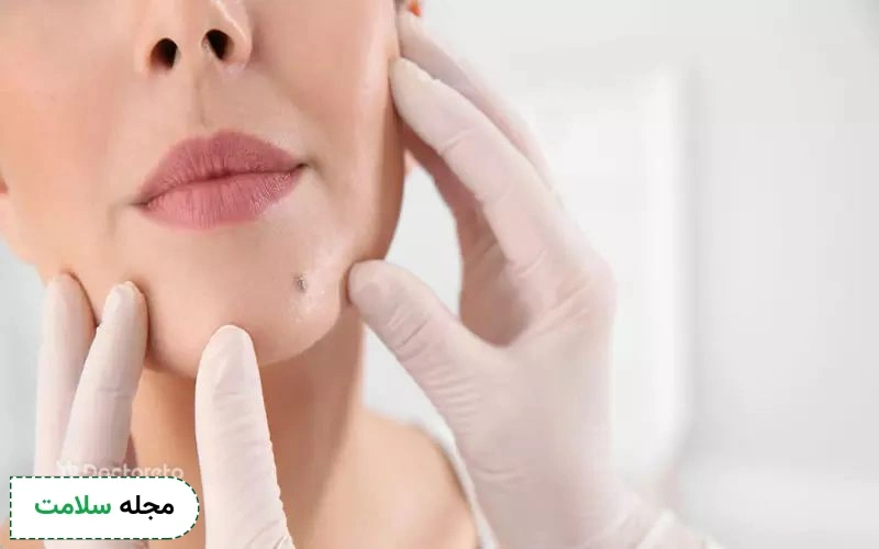 برداشتن خال به روش های مختلف انجام می شود.