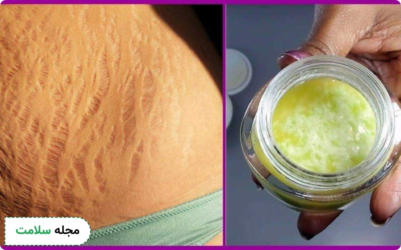 برای کاهش ظاهر ترک‌های پوستی، می‌توان از محصولات حاوی ویتامین E و آلوئه ورا استفاده کرد.