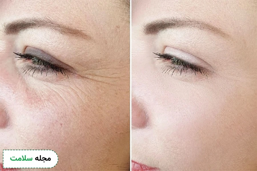 میکرونیدلینگ برای رفع چروک دور چشم