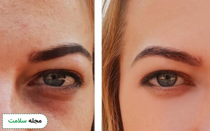 راه های پر شدن و رفع گودی زیر چشم