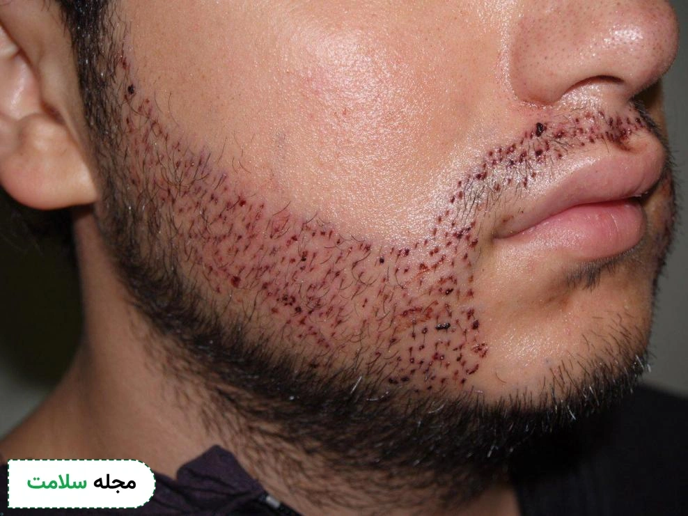 beard-hair-loss
