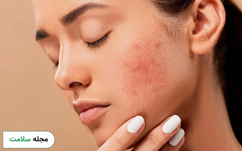 برای درمان جوش صورت چه کنیم؟
