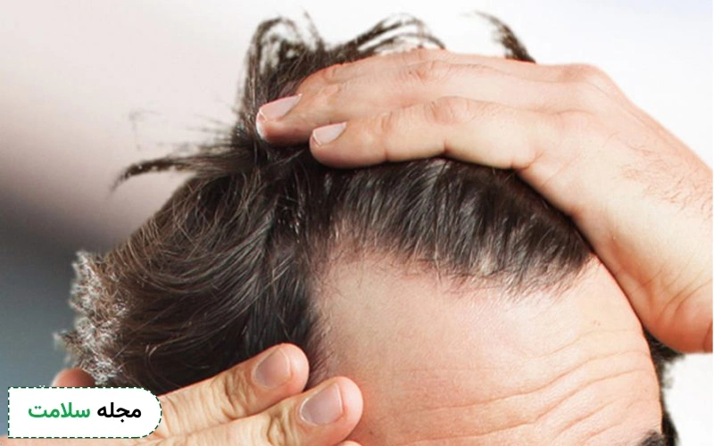 بهترین روش درمان ریزش مو در مردان کدام است؟