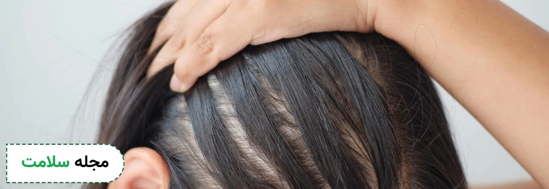 Cause-of-fine-hair-in-women