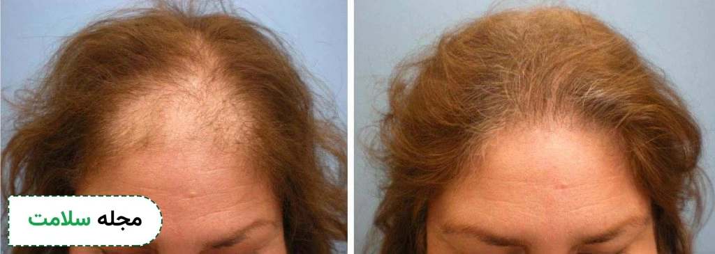 hair-loss-treatments