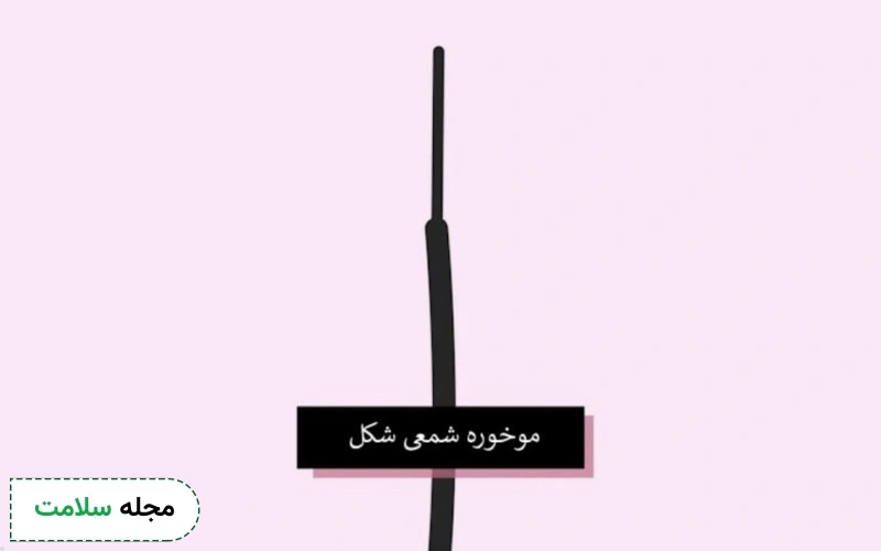 موخوره شمعی چیست؟