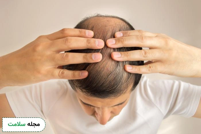 man with hair loss