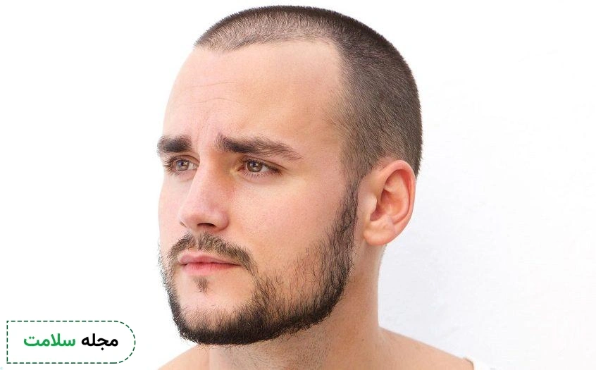 beard-hair-loss