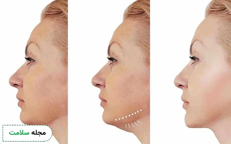 عکس قبل و بعد هایفوتراپی صورت