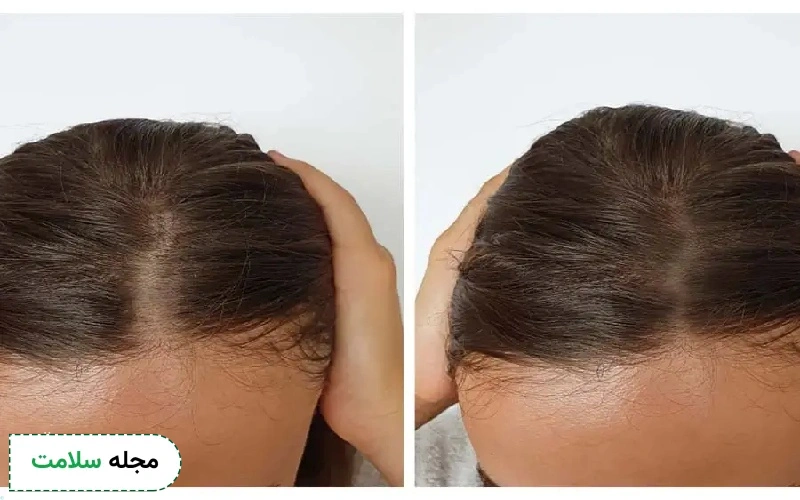 عکس قبل و بعد مزوتراپی مو