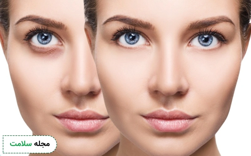 برای رفع گودی زیر چشم چه کنیم؟ انواع درمان خانگی و روش های پزشکی